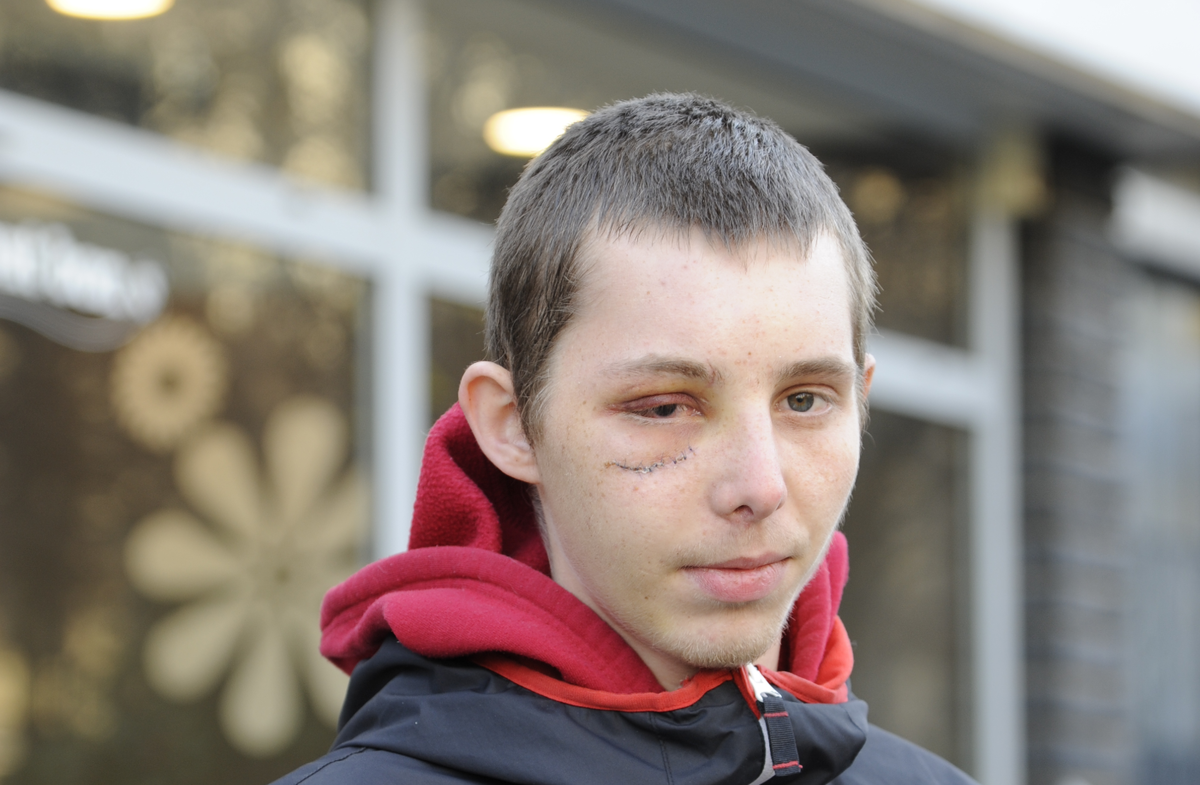 Franck, 20 ans a perdu un oeil après un tir de LBD 40. - © Reflets